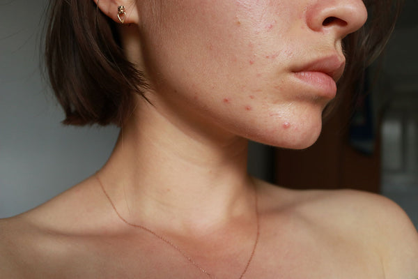 What Is Acne and How Do I Treat It?