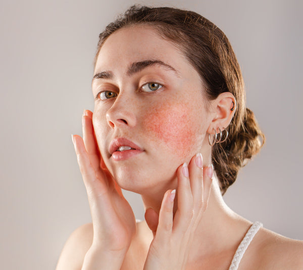 How to care for rosacea skin in the winter gentle products for rosacea skin ingredients to avoid for rosacea